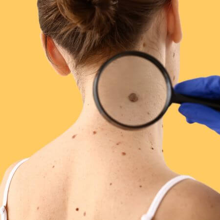 Lumps & Bumps (Skin Lesions) Removal